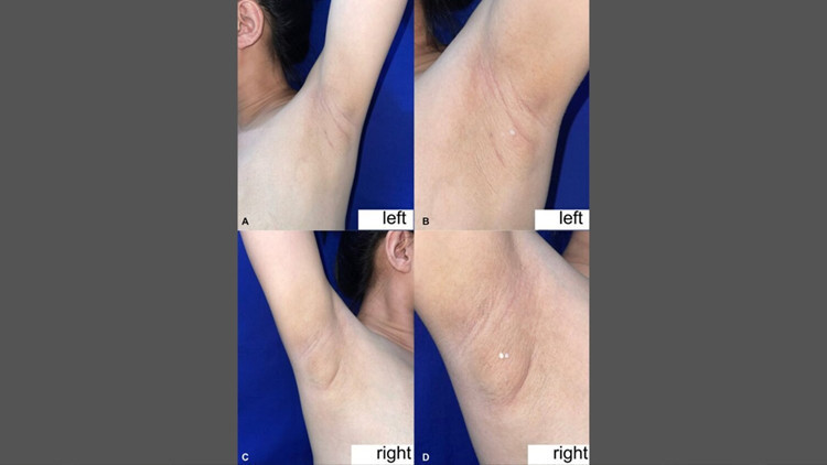 filipinli kadinin koltukaltindan sut geldi nadir gorulen durumun nedeni ne MYn18g8w.jpg